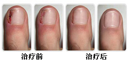上海灰指甲治疗医院(治疗灰指甲的医院)