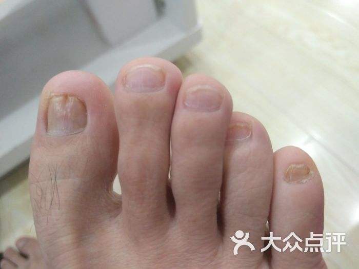 上海治疗灰指甲的医院(上海治疗灰指甲的正规医院)