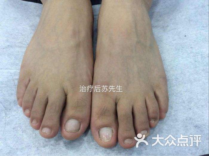 上海治疗灰指甲的医院(上海哪家医院可以治疗灰指甲)