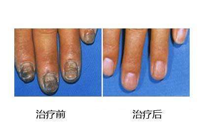 上海治疗灰指甲的医院(上海哪家医院可以治疗灰指甲)