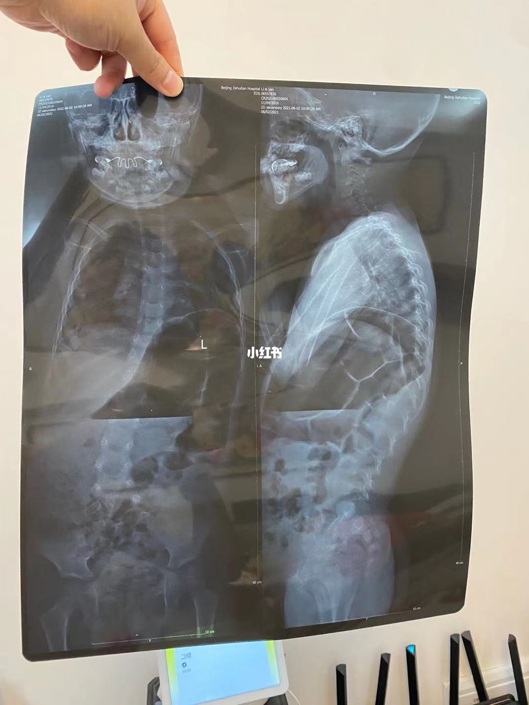 积水潭医院骨科黄牛挂号就是靠谱；X光片、CT、核磁有什么区别?看病用哪个好?一个比喻你就明白了的简单介绍