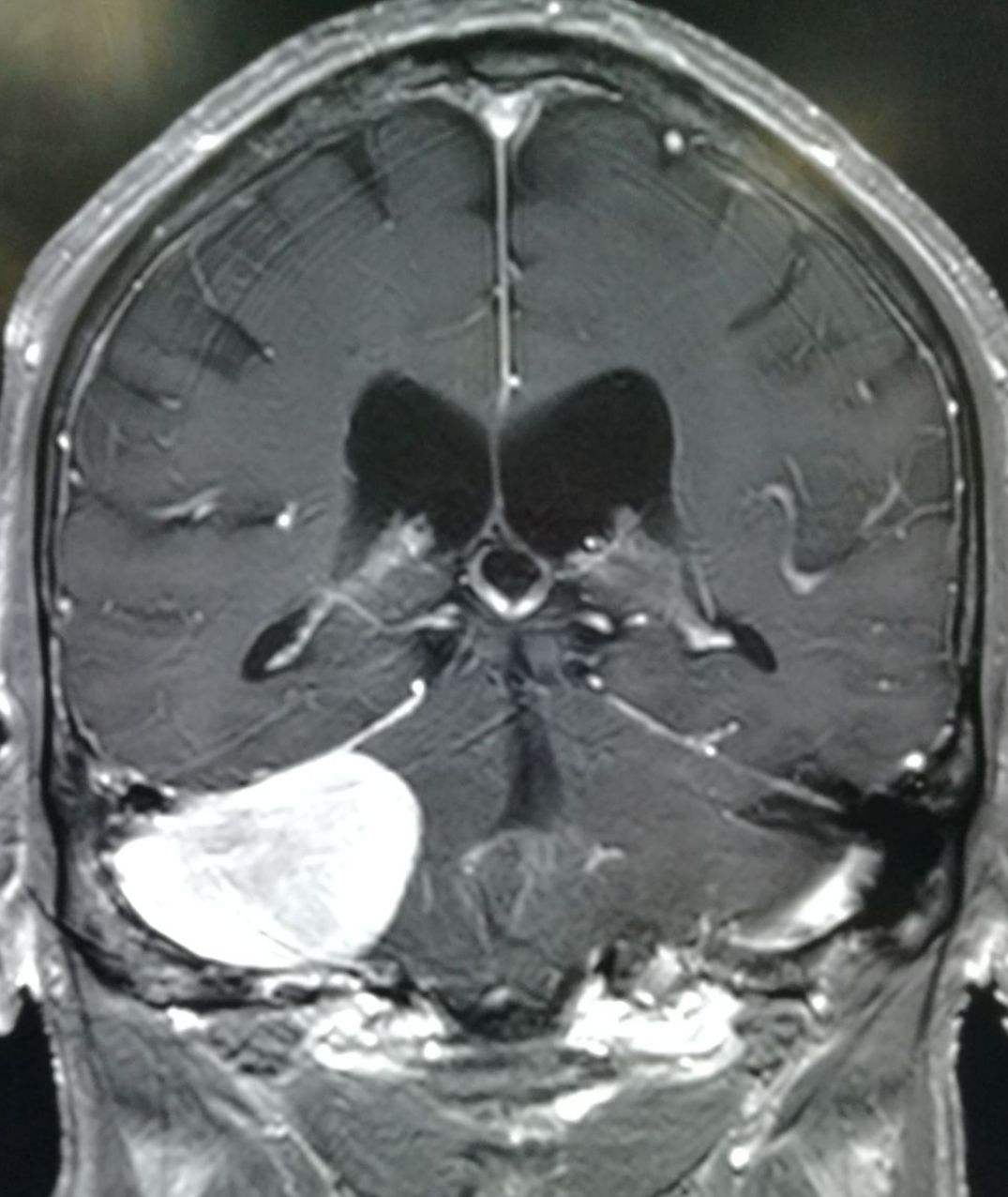 宣武医院脑血管专家黄牛票贩子挂号；大夫，听说放射检查有射线!MRI，就是磁共振，安全吗?的简单介绍