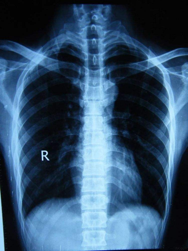关于北京胸科医院号贩子代挂有偿收费绝对靠谱；X光片、CT、核磁有什么区别?看病用哪个好?一个比喻你就明白了的信息