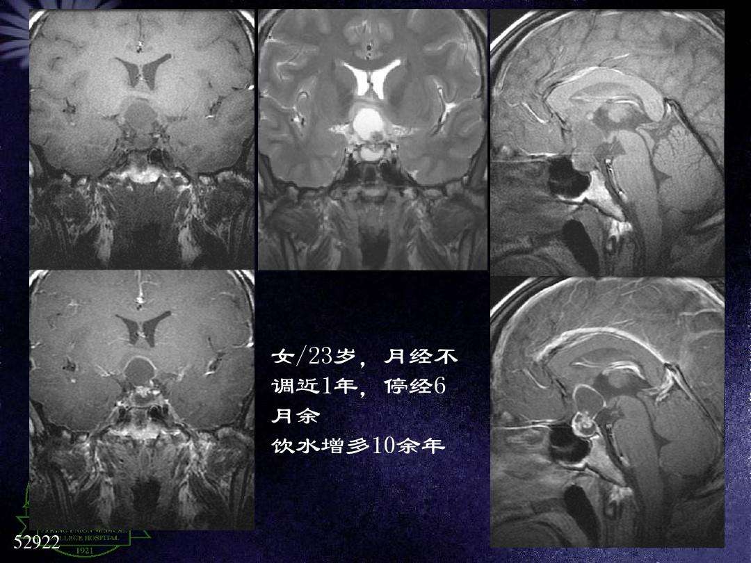 关于北医三院生殖中心【乔杰-马彩虹-刘平】挂号着急找黄牛；肿瘤诊断之磁共振成像(MRI)检查的信息
