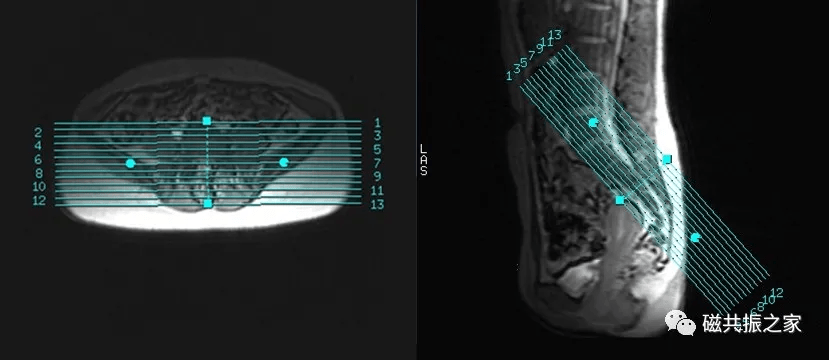 西苑医院号贩子一手挂号就是快；肿瘤诊断之磁共振成像(MRI)检查的简单介绍