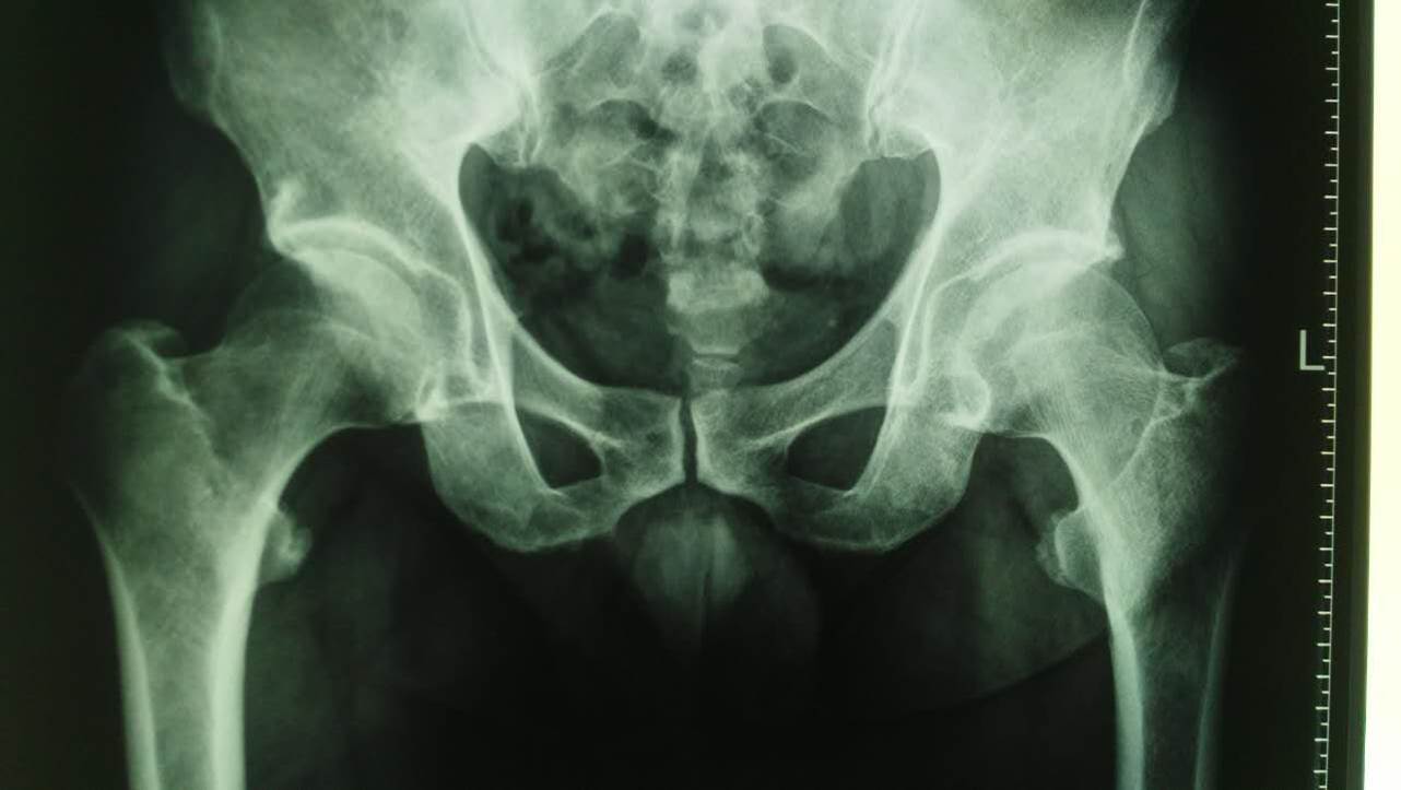包含北医三院产科代挂黄牛是怎么搞到号的；关节炎为什么拍完X光片还需要做超声、核磁?
