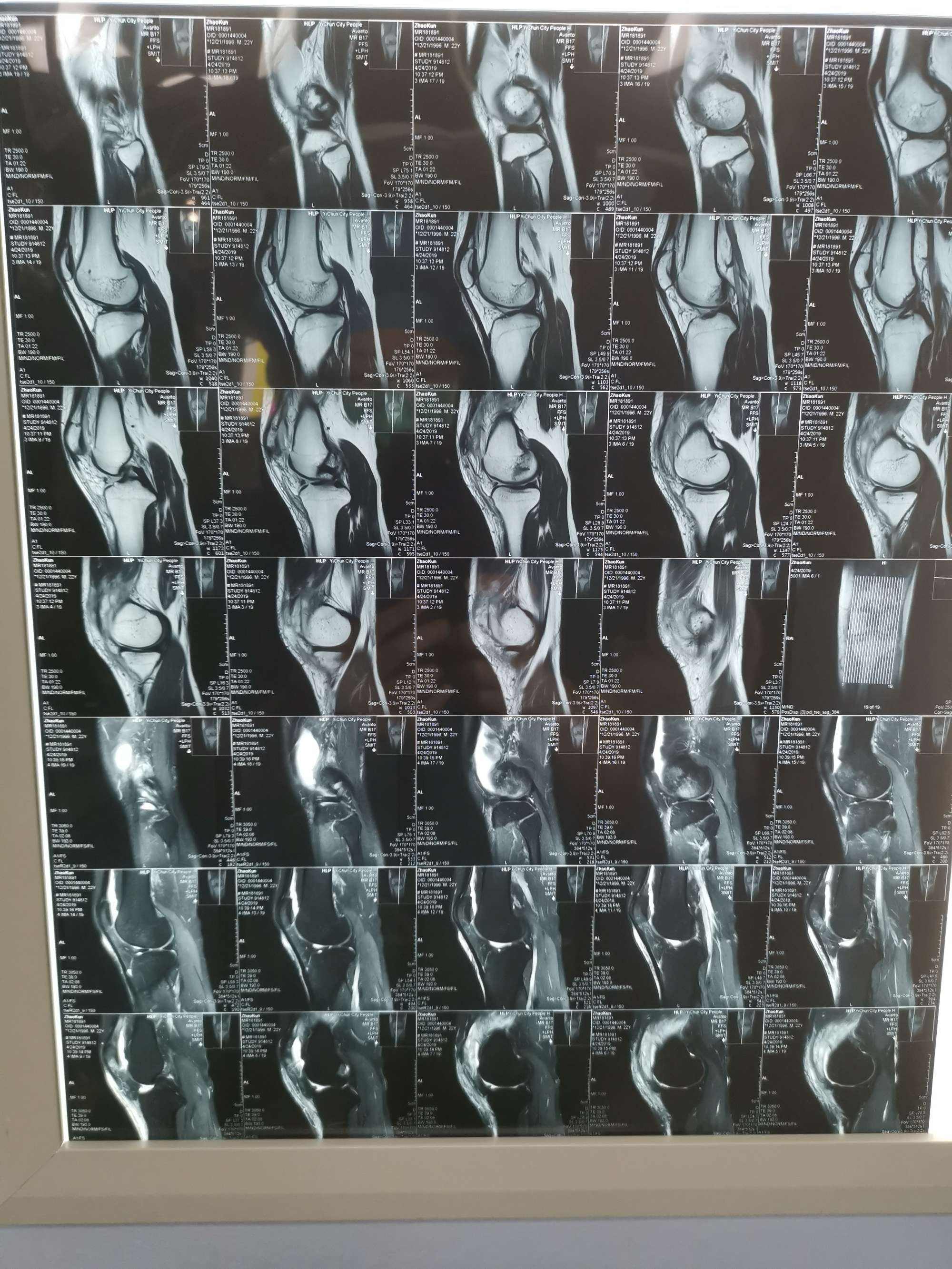 关于北京大学第三医院运动医学骨科黄牛随时帮患者挂号；关节炎为什么拍完X光片还需要做超声、核磁?的信息