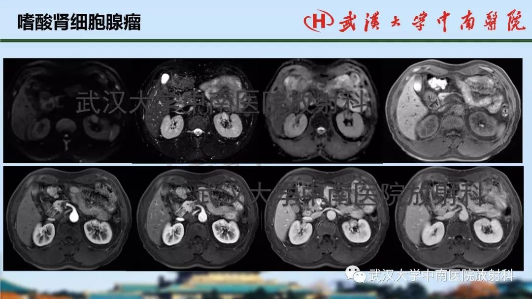 积水潭医院票贩子专业陪诊挂号：DR(X线)、CT、核磁(MRI)到底有什么区别?的简单介绍