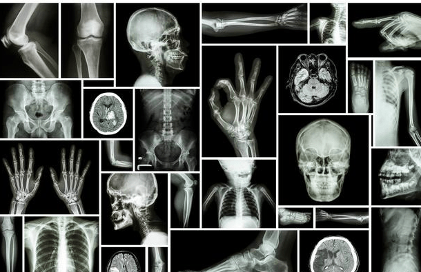 关于积水潭医院骨科黄牛挂号就是靠谱；关节炎为什么拍完X光片还需要做超声、核磁?的信息