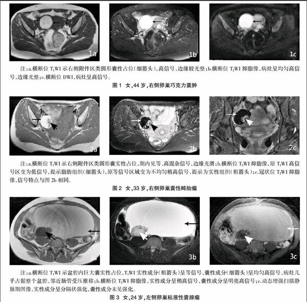 关于安贞医院黄牛挂号京事通肿瘤诊断之磁共振成像(MRI)检查的信息