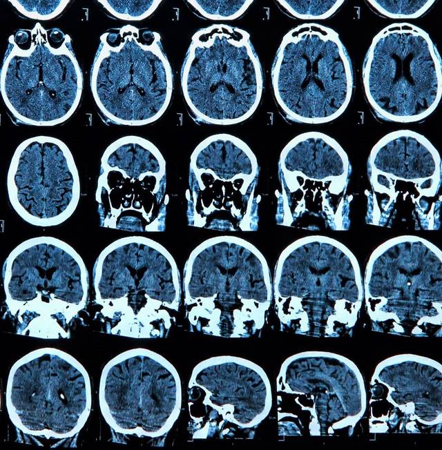 包含宣武医院脑血管专家黄牛票贩子挂号；一文看懂X线、CT与核磁(MRI)的区别的词条