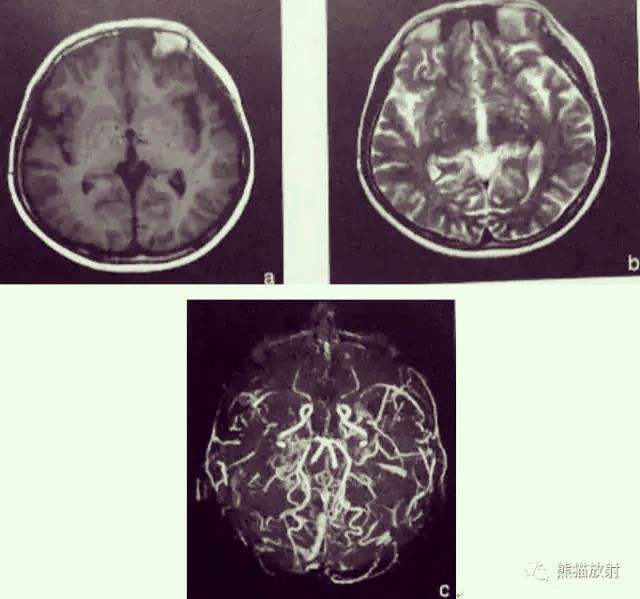 包含安贞医院黄牛挂号京事通一文看懂X线、CT与核磁(MRI)的区别