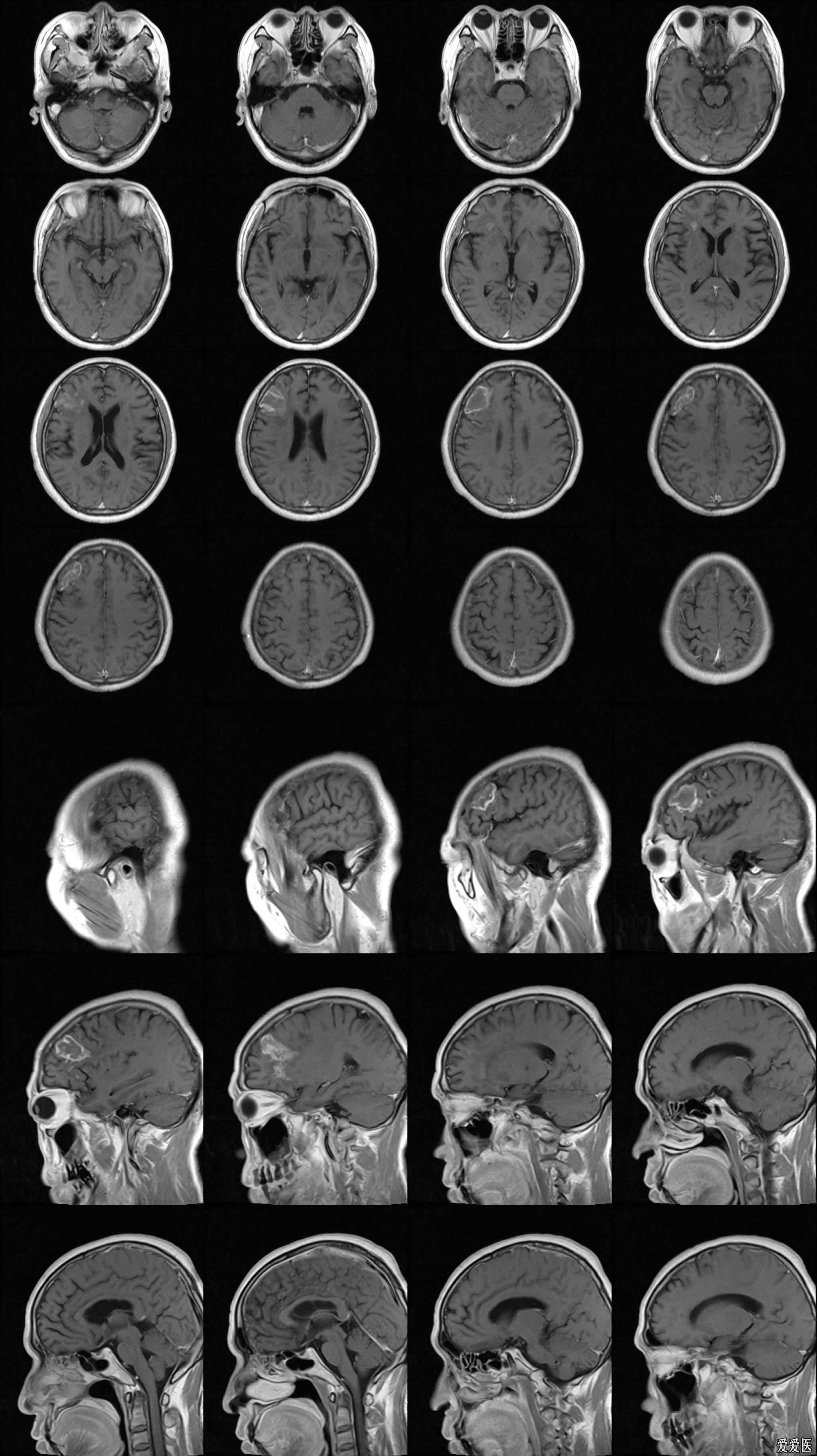 包含安贞医院黄牛挂号京事通一文看懂X线、CT与核磁(MRI)的区别的词条