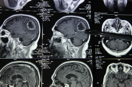 北京儿童医院代挂陪诊服务；长脑肿瘤为什么需要做增强核磁共振?什么是增强核磁共振?的简单介绍