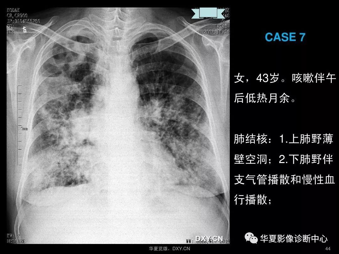 肺癌与肺结核的CT片有何不同?听医生讲2个细节，5分钟学会看CT的简单介绍