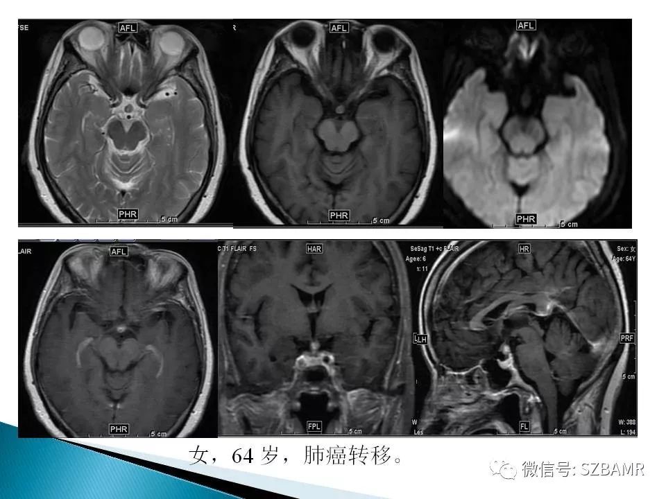包含北京胸科医院号贩子代挂有偿收费绝对靠谱；肿瘤诊断之磁共振成像(MRI)检查的词条