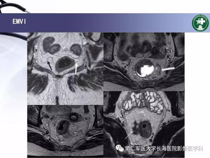 关于安贞医院黄牛挂号京事通「科普」常用的影像学检查——核磁共振(MRI)的信息